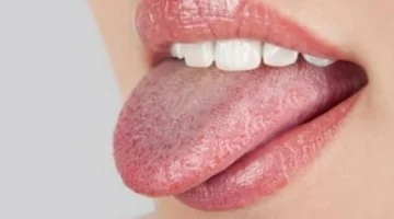 علاج فطريات الفم طبيعيًا.. خبراء يكشفون عن أفضل الحلول المنزلية الآمنة والفعالة